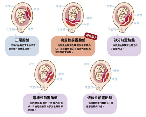 胎盤前置|馬偕紀念醫院 衛教單張：前置胎盤